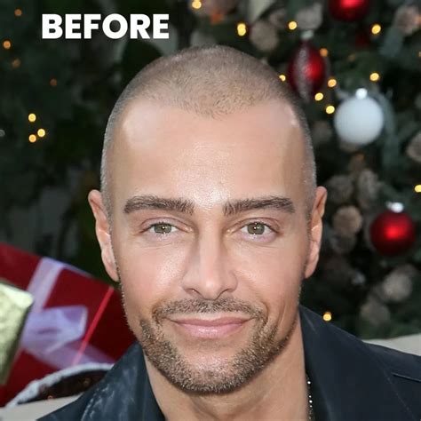 Joey Lawrence Hair Transplant Simulation Result