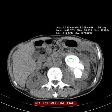 Xanthogranulomatous Pyelonephritis Image