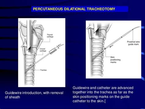 Tracheostomywhen To Perform And How To Manage