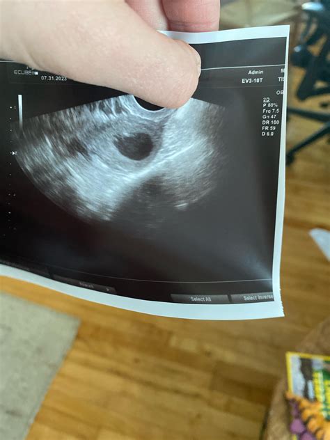 5w4d ultrasound showed only gestational sac, no pole or yolk sac. But