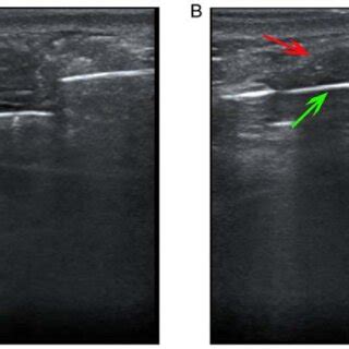 US Guided Mammotome Assisted Minimally Invasive Resection Of A Breast