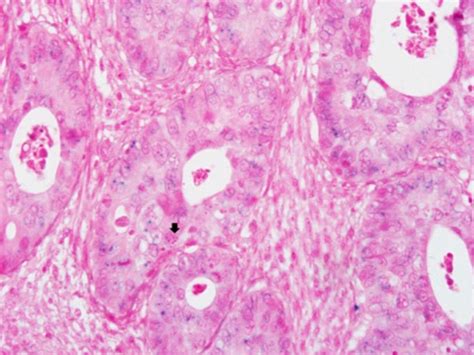 HPV ISH Punctate Signal Pattern H E 400 Presents The ISH Signals