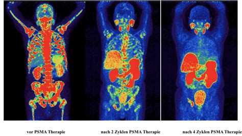 Revolutionary Cancer Treatments Developed By Munich Scientists A