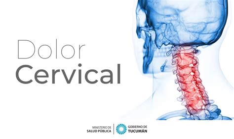 Dolor Cervical La Importancia Del Diagn Stico Y Tratamiento Oportuno