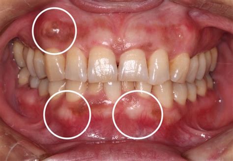 歯茎の腫れと違う「骨隆起」 東京都調布市の歯医者・歯科｜柴崎駅5分の柳沢歯科医院