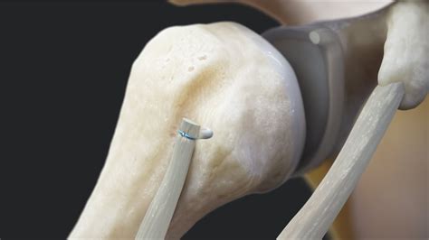 Knotless Fibertak Biceps Implant System For Proximal Biceps Tenodesis