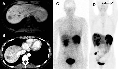 Figure 1 From Safety And Efficacy Of 68Ga DOTATATE PET CT For Diagnosis