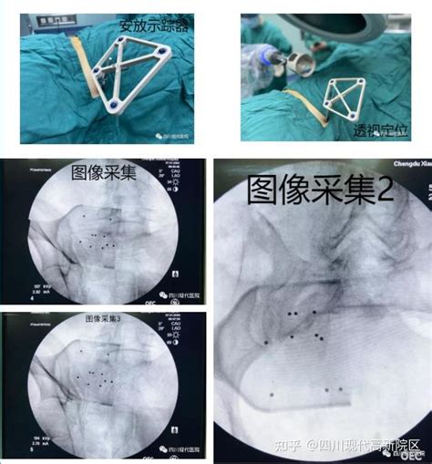 天玑骨科手术机器人助力四川现代医院开启智能化手术新时代 知乎