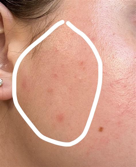 Acne Rosacea Bumps Rskincareaddiction