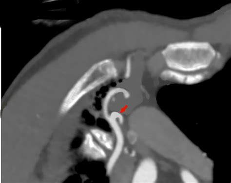 Computed Tomography 2d Multiplanar Reconstruction Shows The Origin Download Scientific