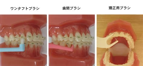 矯正治療中のブラッシングに関して｜渋谷の矯正歯科｜渋谷歯科