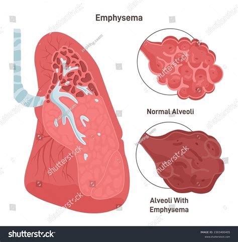 Emphysema Lung Vs Normal Lung