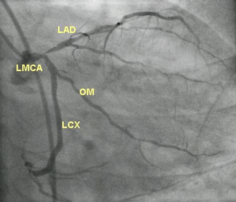 Coronary Artery Plv Coronary Artery