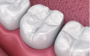 Composite Resin Fillings: A Complete Review - Web DMD