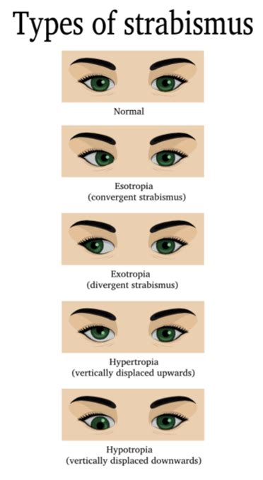 Eye Strengthening Exercises For Crossed Eyes Online Degrees