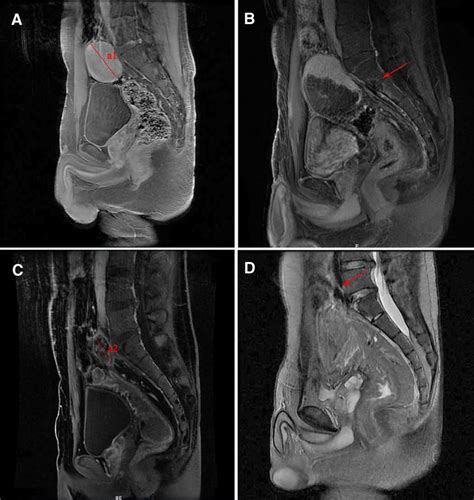 Mri From Patient With A Recurrent Pelvis Desmoid Tumor A Sagittal