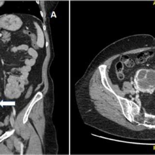 A. CT abdomen with contrast, coronal view. B. CT of the abdomen with ...