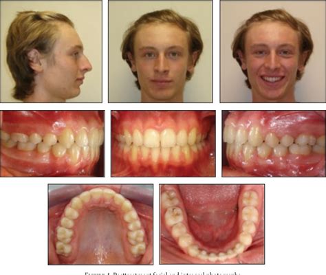 Figure From Treatment Of Class Ii Division Malocclusion Using The