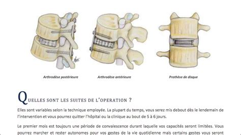 La Discopathie Dégénérative Lombaire Youtube