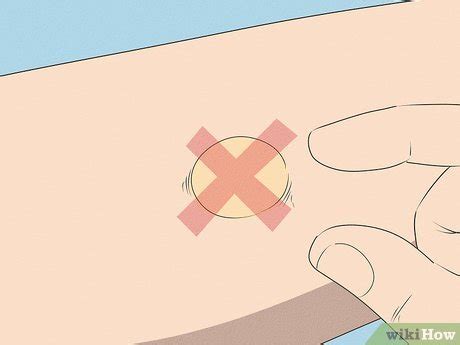 7 Ways to Pop a Blister - wikiHow