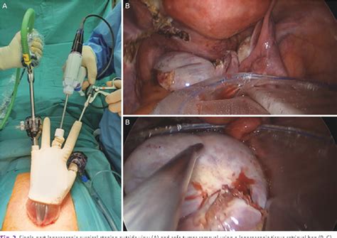 Figure 1 From Comparison Of Single Port Laparoscopy And Laparotomy In