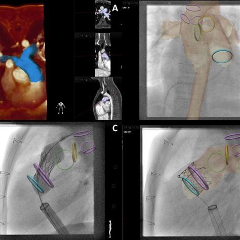 Cmr Guided Endomyocardial Biopsy A Demonstrates Real Time Mr Guided