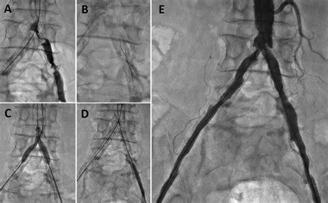 Angiography And Endovascular Therapy For Aortoiliac Artery Disease