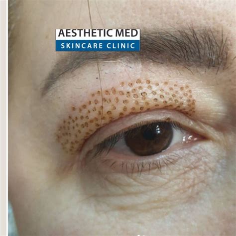 Plasma Fibroblastplasma Lift Upper And Lower Blepharoplasty Aesthetic