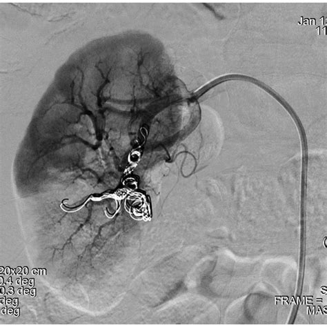 Pre Embolization Angiogram Of The Renal Artery Aneurysm In A