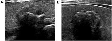 Hounsfield Unit Values In Acr Ti Rads 4 5 Thyroid Nodules With Coarse