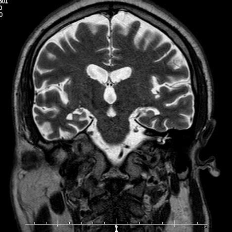 Patient's MRI scan -substantial cortical atrophy in temporal lobes ...