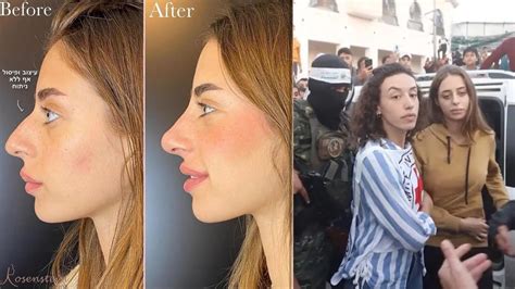 Israeli And Recent Hamas Hostage Mia Schem Gets Nose Job Youtube