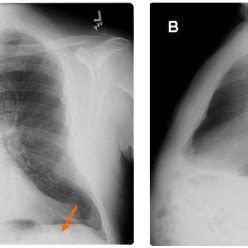 (PDF) The Hoover's Sign of Pulmonary Disease: Molecular Basis and ...