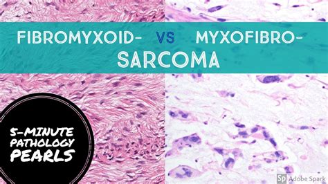 Fibromyxo Vs Myxofibro Sarcoma Made Simple 5 Minute Pathology Pearls Youtube