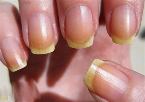 Beautiful Women: Health and Beauty Tip -- Discolored Nails