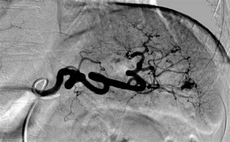 Trauma Embolization Case Albany Ir