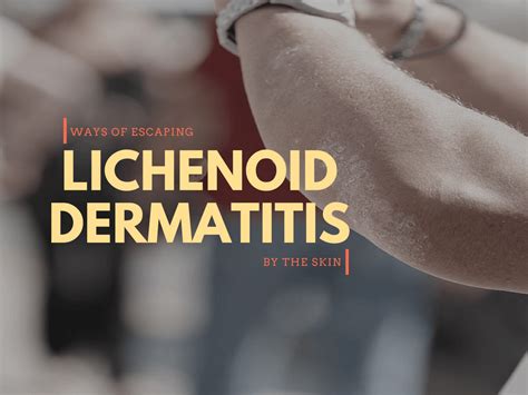 Lichenoid Dermatitis Treatments Causes Symptoms