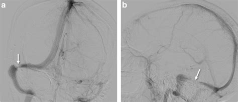 Anteroposterior And Lateral Views Of The Diagnostic Cerebral Angiogram