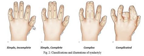 Syndactyly Tran Plastic Surgery