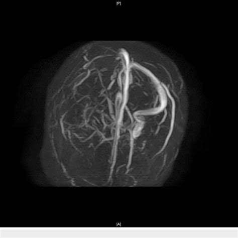 Magnetic Resonance Imaging Mri Venogram Brain Without Contrast Day 1