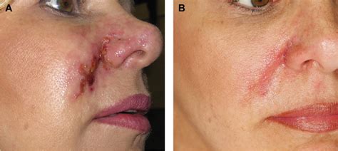 Figure 6 From Complications Of Injectable Fillers Part 2 Vascular