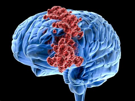 O Que Causa Tumor No Cérebro - O Que Causa Cancer No Cerebro - NAZAEDU