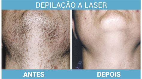 Valores Depila O A Laser Cl Nica De Pele Dr Szerman