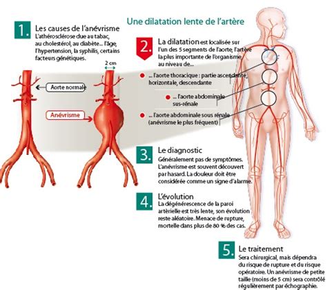 La Rupture D An Vrisme Causes Sympt Mes Cons Quences Traitements