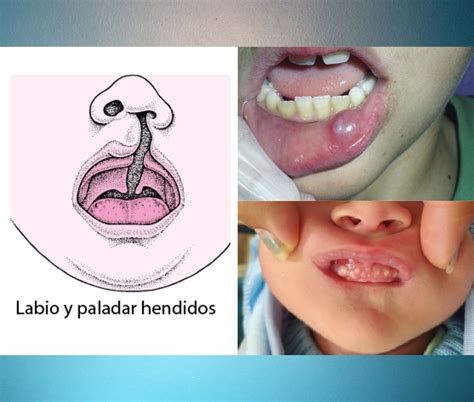 Malformaciones del sistema estomatognático: Congénitas y adquiridas
