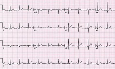 Chapter 1 – The Normal Electrocardiogram | Thoracic Key