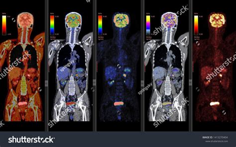 Positron Emission Tomography Pet Ct Scan Stock Illustration 1413270404 ...