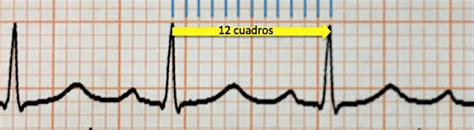 🥇 【 Determinando La Frecuencia Cardiaca Con El Ecg Electrocardiografía Básica