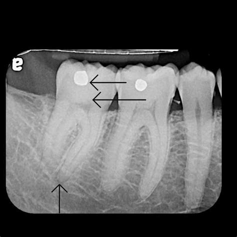 Tooth Abscess X Ray