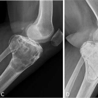 A C Case No 6 Male 15 Years Of Age With GCTB At The Distal Femur